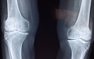 Getting SSD Benefits with Degenerative Joint Disease