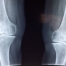 Getting SSD Benefits with Degenerative Joint Disease