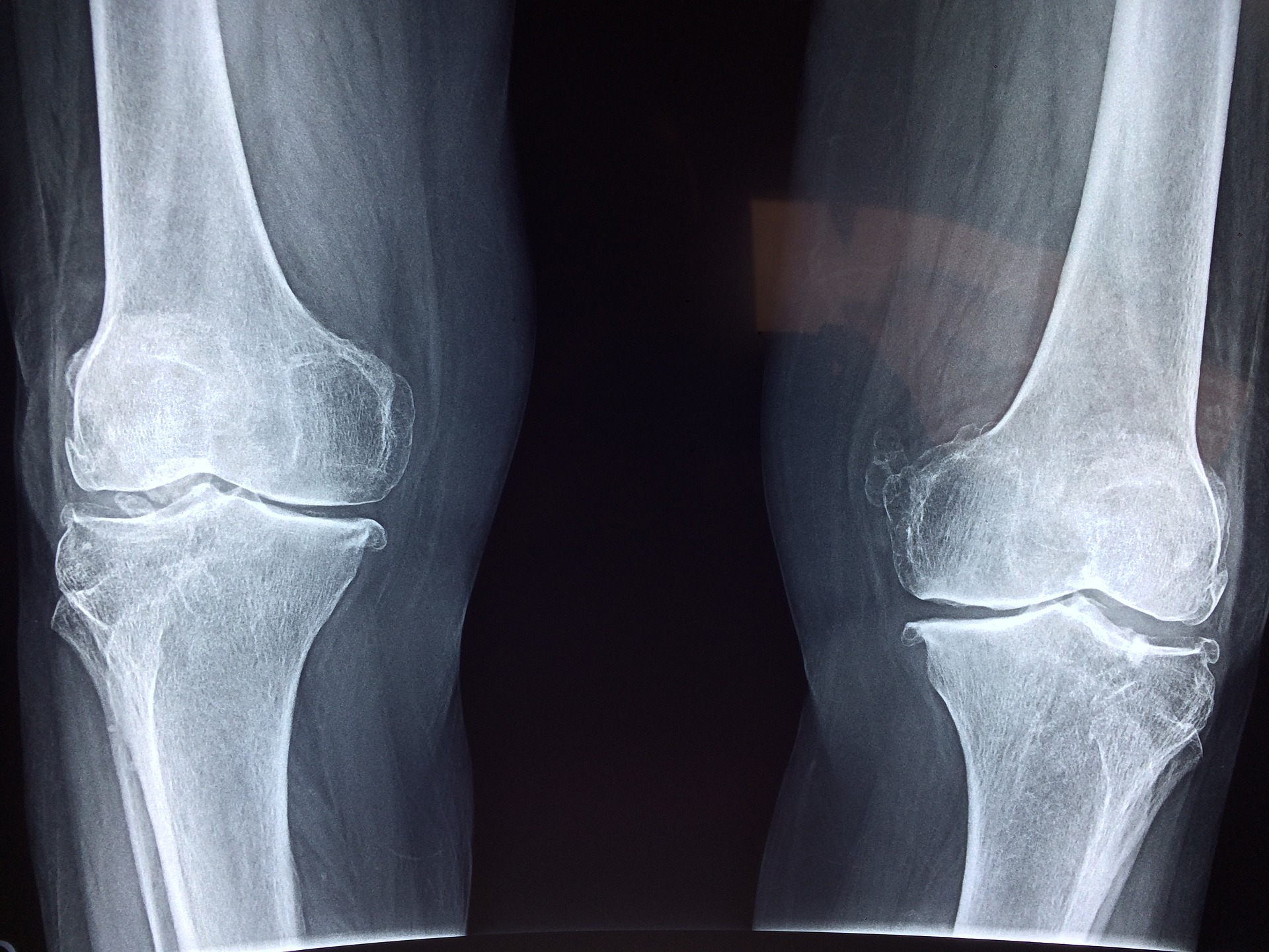 Getting SSD Benefits with Degenerative Joint Disease
